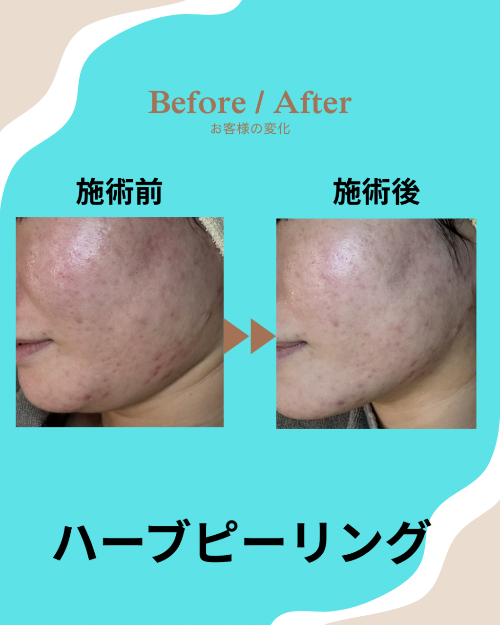 【🌿ハーブピーリング🌿】伊賀市名張市メンズ脱毛メンズエステ