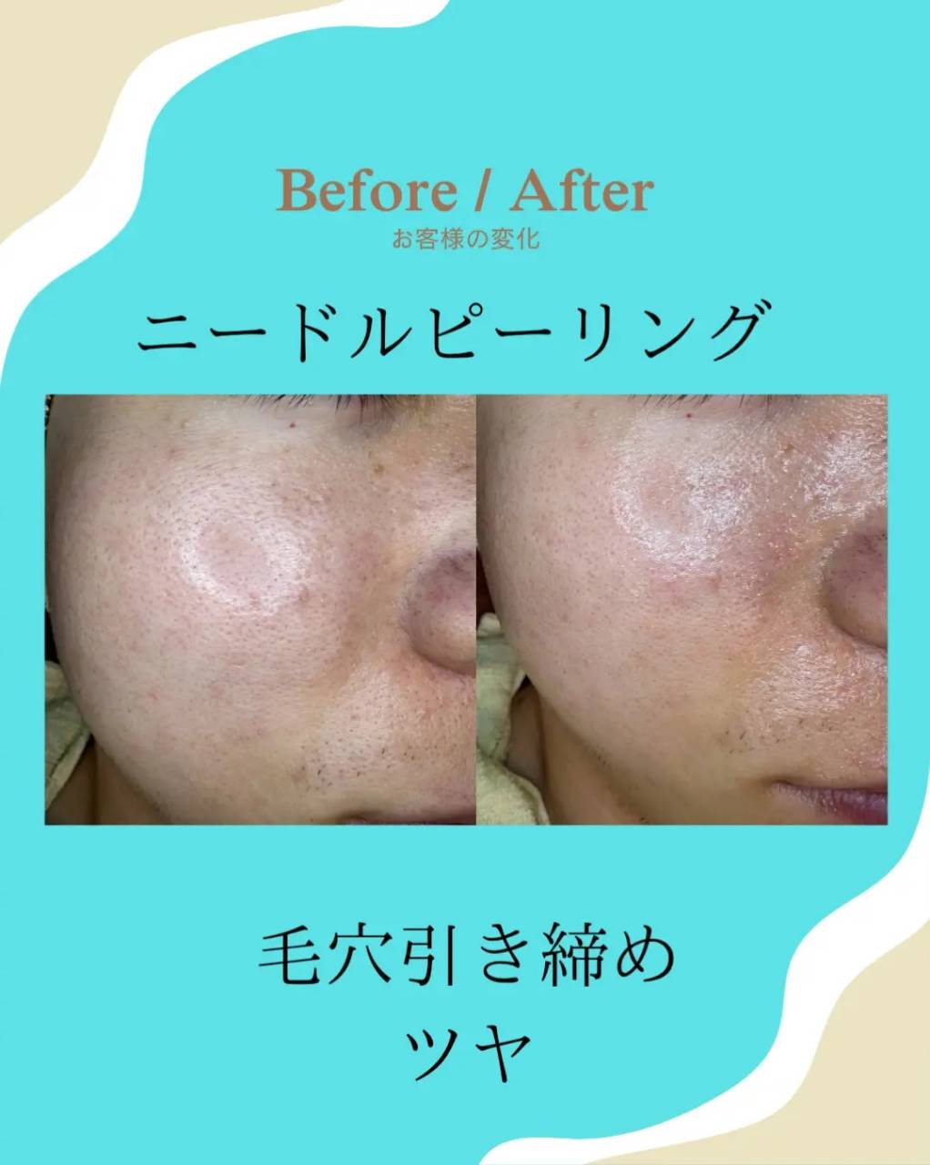 【ニードルピーリング】伊賀市、名張市、メンズ脱毛、メンズエステ