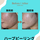 【🌿ハーブピーリング🌿】伊賀市名張市メンズ脱毛メンズエステ